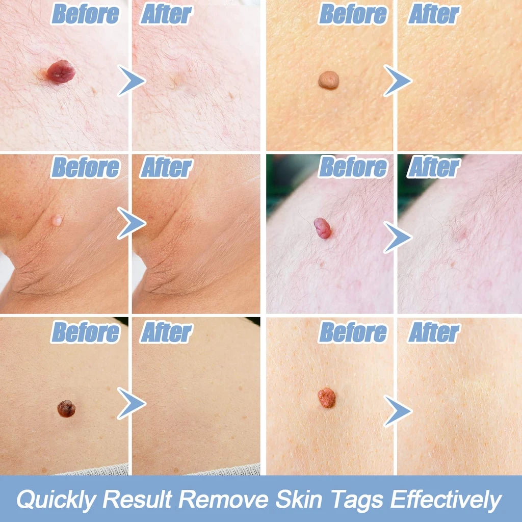 Skin Tag Kill Skin Mole Wart Remover Micro Skin Tag Removal Kit With Cleansing Swabs Adult Mole Wart Face Care