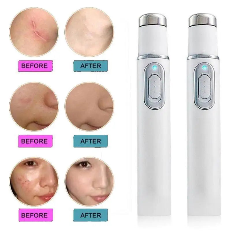 Blue Light Therapy Acne Laser Pen,LED Face Light Therapy For Scar Wrinkle Removal Treatment Device,Skin Care Beauty Appliances