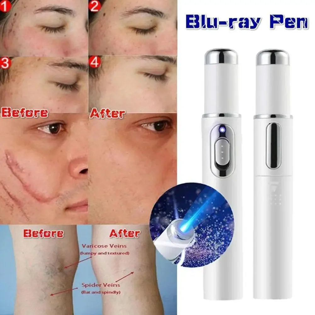 Blue Light Therapy Acne Laser Pen,LED Face Light Therapy For Scar Wrinkle Removal Treatment Device,Skin Care Beauty Appliances