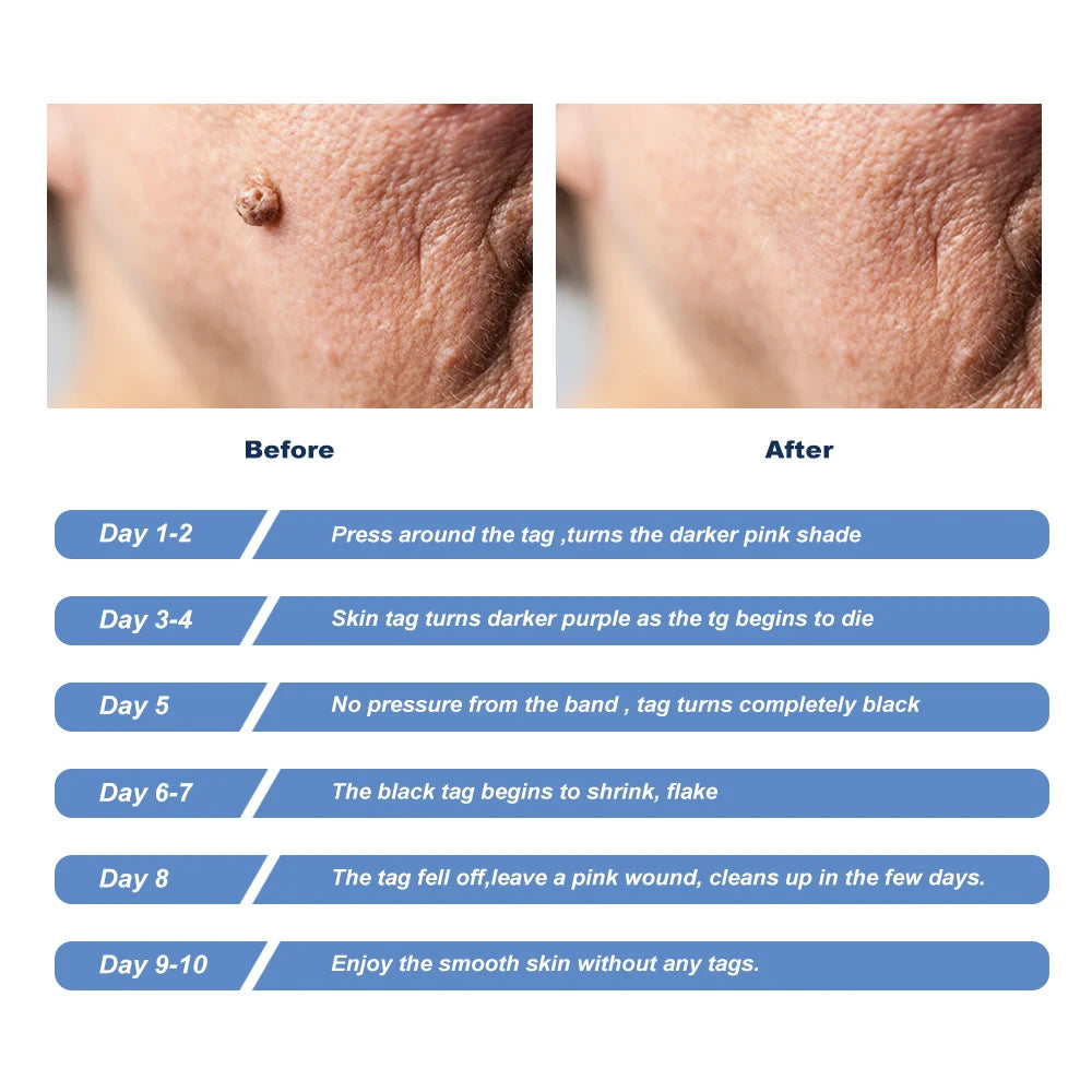 Skin Tag Kill Skin Mole Wart Remover Micro Skin Tag Removal Kit With Cleansing Swabs Adult Mole Wart Face Care